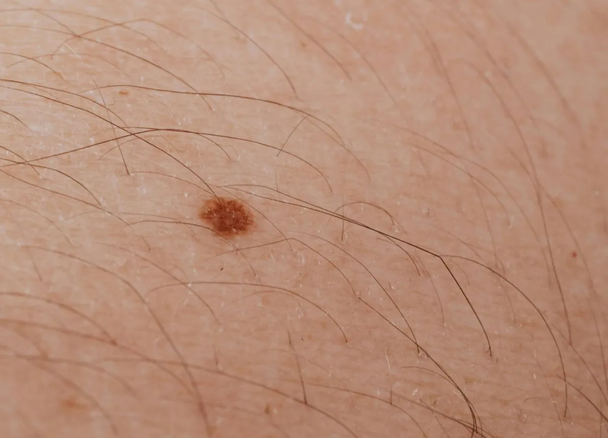 دراسة أسترالية تتوقع انخفاض معدل الإصابة بسرطان الجلد بين الأطفال